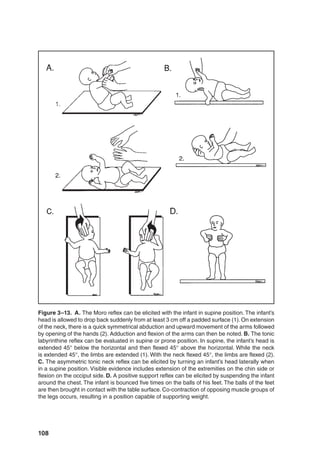 108
Figure 3–13. A. The Moro reflex can be elicited with the infant in supine position. The infant’s
head is allowed to drop back suddenly from at least 3 cm off a padded surface (1). On extension
of the neck, there is a quick symmetrical abduction and upward movement of the arms followed
by opening of the hands (2). Adduction and flexion of the arms can then be noted. B. The tonic
labyrinthine reflex can be evaluated in supine or prone position. In supine, the infant’s head is
extended 45° below the horizontal and then flexed 45° above the horizontal. While the neck
is extended 45°, the limbs are extended (1). With the neck flexed 45°, the limbs are flexed (2).
C. The asymmetric tonic neck reflex can be elicited by turning an infant’s head laterally when
in a supine position. Visible evidence includes extension of the extremities on the chin side or
flexion on the occiput side. D. A positive support reflex can be elicited by suspending the infant
around the chest. The infant is bounced five times on the balls of his feet. The balls of the feet
are then brought in contact with the table surface. Co-contraction of opposing muscle groups of
the legs occurs, resulting in a position capable of supporting weight.
 
