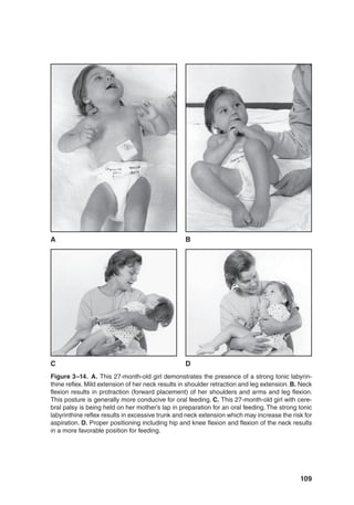 109
Figure 3–14. A. This 27-month-old girl demonstrates the presence of a strong tonic labyrin-
thine reflex. Mild extension of her neck results in shoulder retraction and leg extension. B. Neck
flexion results in protraction (forward placement) of her shoulders and arms and leg flexion.
This posture is generally more conducive for oral feeding. C. This 27-month-old girl with cere-
bral palsy is being held on her mother’s lap in preparation for an oral feeding. The strong tonic
labyrinthine reflex results in excessive trunk and neck extension which may increase the risk for
aspiration. D. Proper positioning including hip and knee flexion and flexion of the neck results
in a more favorable position for feeding.
C
A B
D
 