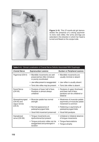 110
Figure 3–15. This 27-month-old girl demon-
strates the presence of a strong asymmet-
ric tonic neck reflex. Her arms and legs are
extended in the direction in which her head is
turned and flexed on the occiput side.
Table 3–5. Clinical Localization of Cranial Nerve Deficits Associated With Dysphagia
Cranial Nerve Supranuclear Lesions Nuclear or Peripheral Lesions
Trigeminal (CN V) • Mandible movements are well
preserved but often immature
or poorly coordinated
• Mandible movements are
usually minimal or absent
• Jawreflexpresentorexaggerated • Jaw reflex is usually absent
• Tonic bite reflex may be present • Tonic bite reflex is absent
Facial Nerve
(CN VII)
• Paralysis of lower half of face.
Paralysis is almost always
unilateral
• Paralysis of upper (forehead)
and lower half of face;
paralysis can be unilateral or
bilateral
Glossopharyngeal
(CN IX) and
vagus nerves
(CN X)
• Muscular palate has normal
strength
• Weakness of muscular palate;
asymmetry of muscular palate
movement is common
• Normal appearance of
palatopharyngeal folds
• Flattening or asymmetry of
palatopharyngeal folds
• Vocal fold movement preserved • Vocal fold paralysis
Hypoglossal
nerve (CN XII)
• Tongue movements are
dysfunctional but present
• Unilateral or bilateral absence
of tongue movements
• Tongue protrusion reflex can be
exaggerated and prolonged in
duration
• Tongue fasciculations
• Tongue atrophy
 