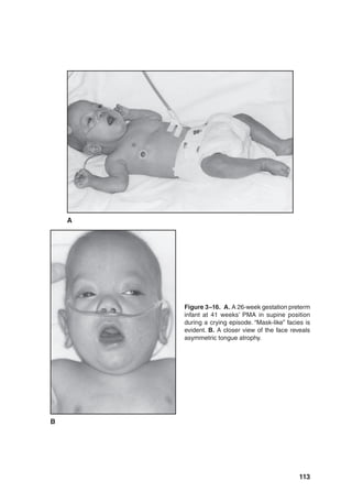 113
Figure 3–16. A. A 26-week gestation preterm
infant at 41 weeks’ PMA in supine position
during a crying episode. “Mask-like” facies is
evident. B. A closer view of the face reveals
asymmetric tongue atrophy.
B
A
 
