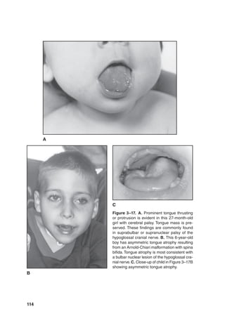 114
Figure 3–17. A. Prominent tongue thrusting
or protrusion is evident in this 27-month-old
girl with cerebral palsy. Tongue mass is pre-
served. These findings are commonly found
in suprabulbar or supranuclear palsy of the
hypoglossal cranial nerve. B. This 6-year-old
boy has asymmetric tongue atrophy resulting
from an Arnold-Chiari malformation with spina
bifida. Tongue atrophy is most consistent with
a bulbar nuclear lesion of the hypoglossal cra-
nial nerve.C. Close-up of child in Figure 3–17B
showing asymmetric tongue atrophy.
B
A
C
 