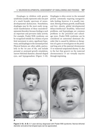 3. Neurodevelopmental Assessment of Swallowing and Feeding  127
Dysphagia in children with genetic
syndromes usually represents only one part
of a much broader spectrum of neuro­
developmental dysfunction. Nonetheless,
dysphagia may be the most easily recog-
nized manifestation of these neurodevel-
opmental disorders because feeding is such
an important and pervasive daily activity.
For example, Prader-Willi syndrome can
be recognized initially by a history of poor
fetal movement in utero, significant hypo-
tonia, and dysphagia in the neonatal period.
Physical features are often subtle, particu-
larly in the 1st year of life, and include
prenatal or postnatal growth retardation,
narrow bifrontal diameter, almond-shaped
eyes, and hypogonadism (Figure 3–18).
Dysphagia is often severe in the neonatal
period, commonly requiring nasogastric
tube feeding; however, it is usually tran-
sient. Slowing of linear growth, small hands
and feet, obesity, global developmental
delays/intellectual disability, behavioral
problems, and hyperphagia are common
problems in the preschool and school-
age years. Prader-Willi syndrome can be
considered an autosomal dominant dis­
order that is caused by deletion or disrup-
tion of a gene or several genes on the proxi-
mal long arm of the paternal chromosome
15 or maternal uniparental disomy 15, due
to the fact that gene(s) on the maternal
chromosome(s) 15 are virtually inactive
through imprinting.
Figure 3–18. A–B. A 1-year-old boy diagnosed with Prader-Willi syndrome. Narrow bifrontal
diameter and abnormal-shaped eyes can be appreciated.
A B
 