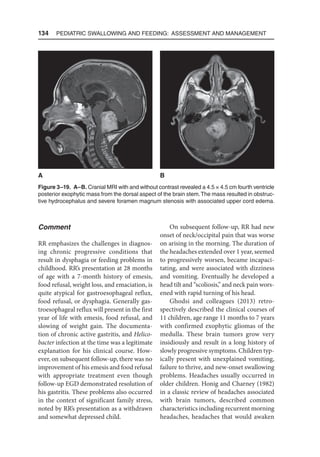 134  Pediatric Swallowing and Feeding: Assessment and Management
Comment
RR emphasizes the challenges in diagnos-
ing chronic progressive conditions that
result in dysphagia or feeding problems in
childhood. RR’s presentation at 28 months
of age with a 7-month history of emesis,
food refusal, weight loss, and emaciation, is
quite atypical for gastroesophageal reflux,
food refusal, or dysphagia. Generally gas-
troesophageal reflux will present in the first
year of life with emesis, food refusal, and
slowing of weight gain. The documenta-
tion of chronic active gastritis, and Helico-
bacter infection at the time was a legitimate
explanation for his clinical course. How-
ever, on subsequent follow-up, there was no
improvement of his emesis and food refusal
with appropriate treatment even though
follow-up EGD demonstrated resolution of
his gastritis. These problems also occurred
in the context of significant family stress,
noted by RR’s presentation as a withdrawn
and somewhat depressed child.
On subsequent follow-up, RR had new
onset of neck/occipital pain that was worse
on arising in the morning. The duration of
the headaches extended over 1 year, seemed
to progressively worsen, became incapaci-
tating, and were associated with dizziness
and vomiting. Eventually he developed a
head tilt and “scoliosis,” and neck pain wors-
ened with rapid turning of his head.
Ghodsi and colleagues (2013) retro-
spectively described the clinical courses of
11 children, age range 11 months to 7 years
with confirmed exophytic gliomas of the
medulla. These brain tumors grow very
insidiously and result in a long history of
slowly progressive symptoms. Children typ-
ically present with unexplained vomiting,
failure to thrive, and new-onset swallowing
problems. Headaches usually occurred in
older children. Honig and Charney (1982)
in a classic review of headaches associated
with brain tumors, described common
characteristics including recurrent morning
headaches, headaches that would awaken
Figure 3–19. A–B. Cranial MRI with and without contrast revealed a 4.5 × 4.5 cm fourth ventricle
posterior exophytic mass from the dorsal aspect of the brain stem.The mass resulted in obstruc-
tive hydrocephalus and severe foramen magnum stenosis with associated upper cord edema.
A B
 