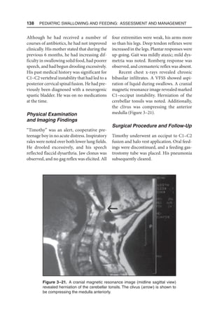 138  Pediatric Swallowing and Feeding: Assessment and Management
Although he had received a number of
courses of antibiotics, he had not improved
clinically. His mother stated that during the
previous 6 months, he had increasing dif-
ficulty in swallowing solid food, had poorer
speech, and had begun drooling excessively.
His past medical history was significant for
C1–C2 vertebral instability that had led to a
posterior cervical spinal fusion. He had pre-
viously been diagnosed with a neurogenic
spastic bladder. He was on no medications
at the time.
Physical Examination
and Imaging Findings
“Timothy” was an alert, cooperative pre-
teenage boy in no acute distress. Inspiratory
rales were noted over both lower lung fields.
He drooled excessively, and his speech
reflected flaccid dysarthria. Jaw clonus was
observed, and no gag reflex was elicited. All
four extremities were weak, his arms more
so than his legs. Deep tendon reflexes were
increased in the legs. Plantar responses were
up-going. Gait was mildly ataxic; mild dys-
metria was noted. Romberg response was
observed, and cremasteric reflex was absent.
Recent chest x-rays revealed chronic
bibasilar infiltrates. A VFSS showed aspi-
ration of liquid during swallows. A cranial
magnetic resonance image revealed marked
C1–occiput instability. Herniation of the
cerebellar tonsils was noted. Additionally,
the clivus was compressing the anterior
medulla (Figure 3–21).
Surgical Procedure and Follow-Up
Timothy underwent an occiput to C1–C2
fusion and halo vest application. Oral feed-
ings were discontinued, and a feeding gas-
trostomy tube was placed. His pneumonia
subsequently cleared.
Figure 3–21. A cranial magnetic resonance image (midline sagittal view)
revealed herniation of the cerebellar tonsils. The clivus (arrow) is shown to
be compressing the medulla anteriorly.
 