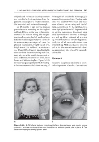 3. Neurodevelopmental Assessment of Swallowing and Feeding  141
ately reduced. For nectar-thick liquids there
was noted to be frank aspiration from the
pyriform sinuses prior to swallow initiation.
She responded with an immediate cough.
At 23 months of age, she was making
guttural sounds, no cooing, but she laughed
out loud. PC was not turning to her moth-
er’s voice. She was not rolling. She was pre-
dominantly moving her left hand and arm
but did not reach or grasp objects. She made
inconsistent responses to parent’s voice. On
physical examination, weight was at 48%,
length was at 35%, and head circumference
was 49 cm (87%). Figure 3–22A highlights
some key facial features including wide face,
deep set eyes, wide mouth, tongue protru-
sion, and flexor posture of her arms, fisted
hands, and NG tube in place. Figure 3–22B
reveals wide spacing of her teeth. Neurolog-
ical examination revealed visual tracking of
red ring in left visual field. Some eye gaze
was noted to examiner’s face. Possible social
smile was inferred? Or noted? She made
some effort to bat at a ring with her left
hand. Arms flexed, R  L, right hand was
more tightly fisted than left. Legs extended,
on vertical suspension. Consistent clasp
knife hypertonia was observed in her right
arm and leg. Observation of left arm and
leg revealed increased variable hypertonia
in flexion of left arm and extensor tone
of the left leg. Mild head lag was noted on
pull to sit. The team recommended a feed-
ing gastrostomy tube when PC was medi-
cally stable.
Comment
In review, Angelman syndrome is a neu-
rodevelopmental disorder characterized
Figure 3–22. A. PC’s facial features including wide face, deep set eyes, wide mouth, tongue
protrusion, and flexor posture of her arms, fisted hands, and nasogastric tube in place. B. Oral
cavity view highlights widely spaced teeth.
A B
 