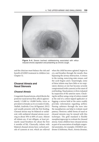 4. The Upper Airway and Swallowing  159
and the clinician must balance the risk and
benefit of GERD treatment in children (see
Chapter 5).
Choanal Atresia and
Nasal Stenosis
Choanal Atresia
Congenital choanal atresia, which blocks the
posterior nasal airway flow, affects approxi-
mately 1:5,000 to 1:8,000 births, twice as
prevalent in females as it is in males (Cedin,
Atallah, Andriolo, Cruz,  Pignatari, 2012)
and usually presents with the first feeding.
Choanal atresia may be bilateral or unilat-
eral, with unilateral choanal atresia occur-
ring in about 50% to 60% of cases. Almost
all infants are, if not obligate, at least pri-
marily nasal breathers for about the first
6 months of life. Classically, infants with
bilateral choanal atresia have cyclical peri-
ods of cyanosis at rest, which are relieved
when the child becomes agitated, begins to
cry, and breathes through the mouth, thus
bypassing the airway obstruction. A return
to the resting, noncrying state ensues, and
the cycle begins anew. Surprisingly, some
of these infants may have little or no respi-
ratory distress at rest but become severely
compromised (with cyanosis) at the onset of
oral feeding. Nasal patency is first evaluated
by inspection of the anterior nares. Check-
ing for airflow using a wisp of cotton created
at the end of a cotton-tipped applicator or
fogging a mirror held at the nares readily
provides information regarding airflow.
Passing catheters through the nose into
the nasopharynx can help to evaluate nasal
patency. However, subtle forms of nasal or
choanal stenosis may be missed with this
technique. The gold standard is flexible
nasopharyngoscopy to evaluate for choanal
atresia. Some children have choanal atresia
as part of an association of multiple congen-
ital anomalies, for example, CHARGE syn-
drome (Coloboma, Heart, Atresia choanae,
Figure 4–4. Severe tracheal cobblestoning associated with reflux-
induced chronic aspiration and presenting as chronic cough.
 
