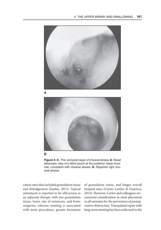 4. The Upper Airway and Swallowing  161
cation rates that included granulation tissue
and dislodgement (Saafan, 2013). Topical
mitomycin is reported to be efficacious as
an adjuvant therapy with less granulation
tissue, lower rate of restenosis, and fewer
surgeries, whereas stenting is associated
with more procedures, greater formation
of granulation tissue, and longer overall
hospital stays (Carter, Lawlor,  Guarisco,
2014). However, Carter and colleagues rec-
ommend consideration to stent placement
in all neonates for the prevention of postop-
erative obstruction. Transpalatal repair with
long-term stenting has been indicated in the
Figure 4–6. Pre- and post-repair of choanal atresia. A. Nasal
telescopic view of a blind pouch at the posterior nasal choa-
nae, consistent with choanal atresia. B. Repaired right cho-
anal atresia.
B
A
 