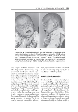 4. The Upper Airway and Swallowing  163
way. Surgical treatment may occur soon
after diagnosis (or later for some). Surgi-
cal methods include open calvarial recon-
struction, minimally invasive strip craniec-
tomy with postoperative molding helmet,
minimally invasive strip craniectomy with
spring implantation, and cranial distrac-
tion (Governale, 2015). Müller-Hagedorn
and colleagues (2018) reported treatment
of airway obstruction with a modified Tub-
ingen Palatal Plate (TPP) as mostly effective
and safe. They emphasized the need for pro-
spective studies that may help avoid more
invasive procedures, such as tracheostomy,
for some children until the diameter of the
airway increases with growth. The airway
may be improved with midface advance-
ment, a procedure that has been performed
in some cases as early as age 3 years, but is
best deferred until after puberty.
Mandibular Hypoplasias
The Pierre Robin sequence classically has
been described by a triad of clinical signs
to include mandibular hypoplasia, micro-
gnathia, glossoptosis (backward, downward
placement of the tongue) (Figure 4–10), and
a U-shaped cleft palate (see Figure 4–1).
This condition is now labeled Pierre Robin
sequence or syndrome with signs described:
micrognathia, glossoptosis, and obstruction
of the upper airways frequently associated
with a palatal cleft (e.g., Cladis et al., 2014;
Figure 4–7. A. Frontal view of an infant with Apert syndrome. Note midface hypo-
plasia in the infant and syndactyly of the affected parent holding the child. B. Lateral
view of infant with Apert syndrome. (Source: From Volk, M. S., Arnold, S.,  Brod-
sky, L. Otolaryngology and audiology. In L. Brodsky, L. Holt,  D. H. Ritter-Schmidt
[Eds.], Craniofacial anomalies: An interdisciplinary approach [p. 172]. St. Louis, MO:
Mosby-Year Book. Copyright 1992 by Mosby-Year Book. Reprinted by permission.)
A B
 