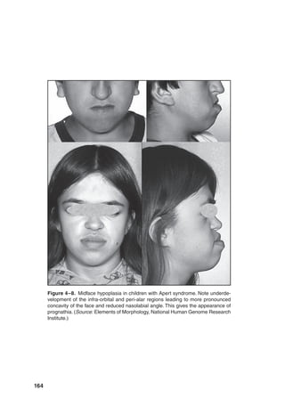 164
Figure 4–8. Midface hypoplasia in children with Apert syndrome. Note underde-
velopment of the infra-orbital and peri-alar regions leading to more pronounced
concavity of the face and reduced nasolabial angle. This gives the appearance of
prognathia. (Source: Elements of Morphology, National Human Genome Research
Institute.)
 