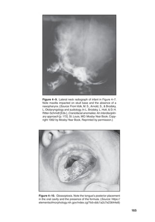 165
Figure 4–9. Lateral neck radiograph of infant in Figure 4–7.
Note maxilla impacted on skull base and the absence of a
nasopharynx.(Source: From Volk, M.S., Arnold, S.,  Brodsky,
L. Otolaryngology and audiology. In L. Brodsky, L. Holt,  D. H.
Ritter-Schmidt [Eds.], Craniofacial anomalies: An interdisciplin-
ary approach [p. 172]. St. Louis, MO: Mosby-Year Book. Copy-
right 1992 by Mosby-Year Book. Reprinted by permission.)
Figure 4–10. Glossoptosis. Note the tongue’s posterior placement
in the oral cavity and the presence of the formula. (Source: https://
elementsofmorphology.nih.gov/index.cgi?tid=ddc1a2c7e23644e8)
 