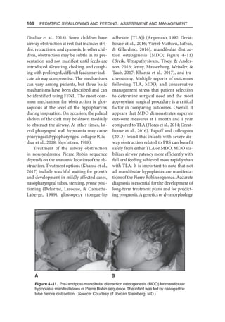 166  Pediatric Swallowing and Feeding: Assessment and Management
Giudice et al., 2018). Some children have
airway obstruction at rest that includes stri-
dor, retractions, and cyanosis. In other chil-
dren, obstruction may be subtle in its pre-
sentation and not manifest until feeds are
introduced. Grunting, choking, and cough-
ing with prolonged, difficult feeds may indi-
cate airway compromise. The mechanisms
can vary among patients, but three basic
mechanisms have been described and can
be identified using FFNL. The most com-
mon mechanism for obstruction is glos-
soptosis at the level of the hypopharynx
during inspiration. On occasion, the palatal
shelves of the cleft may be drawn medially
to obstruct the airway. At other times, lat-
eral pharyngeal wall hypotonia may cause
pharyngeal/hypopharyngeal collapse (Giu-
dice et al., 2018; Shprintzen, 1988).
Treatment of the airway obstruction
in nonsyndromic Pierre Robin sequence
depends on the anatomic location of the ob-
struction. Treatment options (Khansa et al.,
2017) include watchful waiting for growth
and development in mildly affected cases,
nasopharyngeal tubes, stenting, prone posi-
tioning (Delorme, Laroque,  Caouette-
Laberge, 1989), glossopexy (tongue-lip
adhesion [TLA]) (Argamaso, 1992; Great-
house et al., 2016; Viezel-Mathieu, Safran,
 Gilardino, 2016), mandibular distrac-
tion osteogenesis (MDO; Figure 4–11)
(Breik, Umapathysivam, Tivey,  Ander-
son, 2016; Jenny, Massenburg, Weissler, 
Taub, 2017; Khansa et al., 2017), and tra-
cheostomy. Multiple reports of outcomes
following TLA, MDO, and conservative
management stress that patient selection
to determine surgical need and the most
appropriate surgical procedure is a critical
factor in comparing outcomes. Overall, it
appears that MDO demonstrates superior
outcome measures at 1 month and 1 year
compared to TLA (Flores et al., 2014; Great-
house et al., 2016). Papoff and colleagues
(2013) found that infants with severe air-
way obstruction related to PRS can benefit
safely from either TLA or MDO. MDO sta-
bilizes airway patency more efficiently with
full oral feeding achieved more rapidly than
with TLA. It is important to note that not
all mandibular hypoplasias are manifesta-
tions of the Pierre Robin sequence. Accurate
diagnosis is essential for the development of
long-term treatment plans and for predict-
ing prognosis. A genetics or dysmorphology
Figure 4–11. Pre- and post-mandibular distraction osteogenesis (MDO) for mandibular
hypoplasia manifestations of Pierre Robin sequence.The infant was fed by nasogastric
tube before distraction. (Source: Courtesy of Jordan Steinberg, MD.)
A B
 