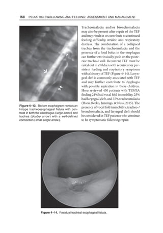168  Pediatric Swallowing and Feeding: Assessment and Management
Tracheomalacia and/or bronchomalacia
may also be present after repair of the TEF
and may result in or contribute to continued
feeding difficulty, stridor, and respiratory
distress. The combination of a collapsed
trachea from the tracheomalacia and the
presence of a food bolus in the esophagus
can further extrinsically push on the poste-
rior tracheal wall. Recurrent TEF must be
ruled out in children with recurrent or per-
sistent feeding and respiratory symptoms
with a history of TEF (Figure 4–14). Laryn-
geal cleft is commonly associated with TEF
and may further contribute to dysphagia
with possible aspiration in these children.
Hseu reviewed 430 patients with TEF/EA
finding 21% had vocal fold immobility, 25%
had laryngeal cleft, and 37% tracheomalacia
(Hseu, Recko, Jennings,  Nuss, 2015). The
presence of vocal fold immobility, tracheo-/
bronchomalacia, and laryngeal cleft should
be considered in TEF patients who continue
to be symptomatic following repair.
Figure 4–13. Barium esophagram reveals an
H-type tracheoesophageal fistula with con-
trast in both the esophagus (large arrow) and
trachea (double arrow) with a well-defined
connection (small single arrow).
Figure 4–14. Residual tracheal esophageal fistula.
 