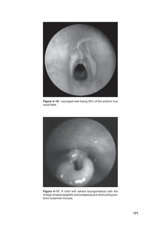 171
Figure 4–17. A child with severe laryngomalacia with the
omega-shaped epiglottis and prolapsing and obstructing pos-
terior arytenoid mucosa.
Figure 4–16. Laryngeal web fusing 50% of the anterior true
vocal folds.
 