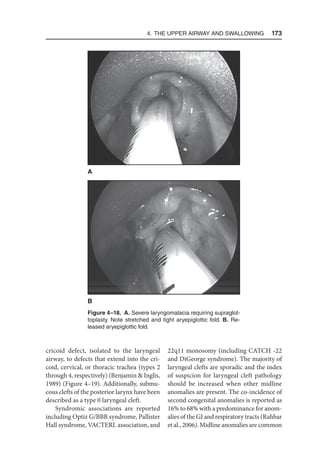 4. The Upper Airway and Swallowing  173
cricoid defect, isolated to the laryngeal
airway, to defects that extend into the cri-
coid, cervical, or thoracic trachea (types 2
through 4, respectively) (Benjamin  Inglis,
1989) (Figure 4–19). Additionally, submu-
cous clefts of the posterior larynx have been
described as a type 0 laryngeal cleft.
Syndromic associations are reported
including Optiz G/BBB syndrome, Pallister
Hall syndrome, VACTERL association, and
22q11 monosomy (including CATCH -22
and DiGeorge syndrome). The majority of
laryngeal clefts are sporadic and the index
of suspicion for laryngeal cleft pathology
should be increased when other midline
anomalies are present. The co-incidence of
second congenital anomalies is reported as
16% to 68% with a predominance for anom-
alies of the GI and respiratory tracts (Rahbar
et al., 2006). Midline anomalies are common
Figure 4–18. A. Severe laryngomalacia requiring supraglot-
toplasty. Note stretched and tight aryepiglottic fold. B. Re-
leased aryepiglottic fold.
B
A
 
