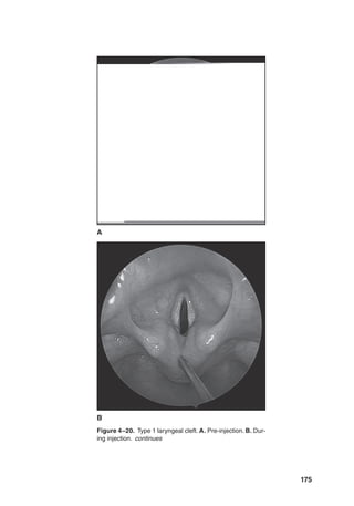 175
Figure 4–20. Type 1 laryngeal cleft. A. Pre-injection. B. Dur-
ing injection. continues
B
A
 