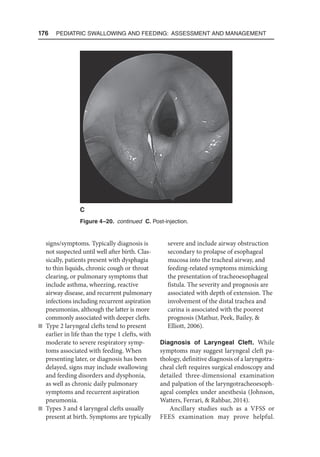 176  Pediatric Swallowing and Feeding: Assessment and Management
signs/symptoms. Typically diagnosis is
not suspected until well after birth. Clas-
sically, patients present with dysphagia
to thin liquids, chronic cough or throat
clearing, or pulmonary symptoms that
include asthma, wheezing, reactive
airway disease, and recurrent pulmonary
infections including recurrent aspiration
pneumonias, although the latter is more
commonly associated with deeper clefts.
n Type 2 laryngeal clefts tend to present
earlier in life than the type 1 clefts, with
moderate to severe respiratory symp-
toms associated with feeding. When
presenting later, or diagnosis has been
delayed, signs may include swallowing
and feeding disorders and dysphonia,
as well as chronic daily pulmonary
symptoms and recurrent aspiration
pneumonia.
n Types 3 and 4 laryngeal clefts usually
present at birth. Symptoms are typically
severe and include airway obstruction
secondary to prolapse of esophageal
mucosa into the tracheal airway, and
feeding-related symptoms mimicking
the presentation of tracheoesophageal
fistula. The severity and prognosis are
associated with depth of extension. The
involvement of the distal trachea and
carina is associated with the poorest
prognosis (Mathur, Peek, Bailey, 
Elliott, 2006).
Diagnosis of Laryngeal Cleft. While
symptoms may suggest laryngeal cleft pa-
thology, definitive diagnosis of a laryngotra-
cheal cleft requires surgical endoscopy and
detailed three-dimensional examination
and palpation of the laryngotracheoesoph-
ageal complex under anesthesia (Johnson,
Watters, Ferrari,  Rahbar, 2014).
Ancillary studies such as a VFSS or
FEES examination may prove helpful.
Figure 4–20. continued  
C. Post-injection.
C
 