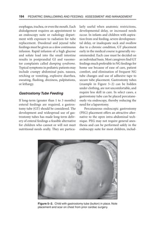 194  Pediatric Swallowing and Feeding: Assessment and Management
esophagus, trachea, or even the mouth. Each
dislodge­
ment requires an appointment to
an endoscopy suite or radiology depart-
ment with exposure to radiation for tube
replacement. Duodenal and jejunal tube
feedings must be given as a slow continuous
infusion. Rapid infusion of a high glucose
and solute load into the small intestine
results in postprandial GI and vasomo-
tor complaints called dumping syndrome.
Typical symptoms in pediatric patients may
include crampy abdominal pain, nausea,
retching or vomiting, explosive diarrhea,
sweating, flushing, dizziness, palpitations,
or lethargy.
Gastrostomy Tube Feeding
If long-term (greater than 1 to 3 months)
enteral feedings are required, a gastros-
tomy tube (GT) should be considered. The
development and widespread use of gas-
trostomy tubes has made long-term deliv-
ery of enteral feedings a feasible alternative
for children who cannot or will not meet
nutritional needs orally. They are particu-
larly useful when anatomic restrictions,
developmental delay, or increased needs
occur. In infants and children with aspira-
tion from oral feeding, severe developmen-
tal delay, or inadequate suck and swallow
due to a chronic condition, GT placement
early in the medical course is generally rec-
ommended. Each case must be decided on
an individual basis. Most caregivers find GT
feedings much preferable to NG feedings for
home use because of ease of care, patient
comfort, and elimination of frequent NG
tube changes and use of adhesive tape to
secure tube placement. Gastrostomy tubes
(example in Figure 5–2) can be hidden
under clothing, are not uncomfortable, and
require less skill in care. In select cases, a
gastrostomy tube can be placed percutane-
ously via endoscopy, thereby reducing the
need for a laparotomy.
Percutaneous endoscopic gastrostomy
(PEG) placement offers an attractive alter-
native to the open intra-abdominal tech-
nique. PEG may not require general anes-
thesia and can be performed safely in the
endoscopy suite for most children, includ-
Figure 5–2. Child with gastrostomy tube (button) in place. Note
placement and scar on chest from prior cardiac surgery.
 