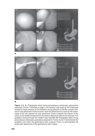 196
Figure 5–3. A. Photographs taken during percutaneous endoscopic gastrostomy
placement. Frame 2 illustrates a bulge in the stomach wall made by the endoscopy
assistant’s finger pressure on the abdomen during attempts to identify a proper loca-
tion for tube placement. Frames 6 and 7 show the placement of a snare by the endos-
copist at the site selected for tube placement. Frame 8 depicts the closure of the
snare on the needle introduced from the anterior abdominal wall into the stomach.The
guidewire coming through the needle is also identified. B. Photographs taken during
percutaneous endoscopic gastrostomy placement. Frames 9 and 11 demonstrate the
guidewire over which the gastrostomy tube is placed. Frame 12 demonstrates the
endoscopic appearance of the gastrostomy tube in place.
B
A
 
