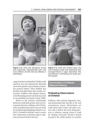 7. Clinical Swallowing and Feeding Assessment  283
range of motion are identified. Children with
spasticity also may demonstrate abnormal
movement patterns and remnants of primi-
tive postural reflexes. These children may
develop joint deformities that include con-
tractures. Children with athetosis demon-
strate fluctuating muscle tone that may result
in uncontrolled movements (Locke, 2008).
Based on the intricate relationships
between overall body posture and oral sen-
sorimotor function, children with CNS dis-
orders and abnormal muscle tone are at risk
for oral pharyngeal dysphagia (Benfer et al.,
2013). Evaluators therefore need to assess
tone and posture to develop a plan to opti-
mize oral sensorimotor function.
Examination of Children
(Beyond Infancy)
Prefeeding Observations
of Children
Problems with postural alignment, tone,
and positioning relate directly to the oral
sensorimotor system. Observations are
made about head, trunk, and pelvic pos-
ture with a child in the usual sitting posi-
tion in whatever seating system is used
for feeding. Particular attention should
be paid to the child’s posture to correlate
Figure 7–2. Child with decreased muscle
tone (hypotonia), hyperextended neck, and
trunk shifted to the left. She has difficulty in
self-feeding.
Figure 7–3. Child with cerebral palsy who
has increased muscle tone (hypertonia) with
increased flexion in upper extremities. She
has difficulty in self-feeding and needs pos-
tural support.
 