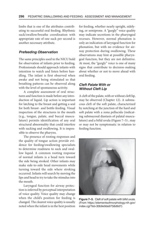 296  Pediatric Swallowing and Feeding: Assessment and Management
limbs that is one of the attributes contrib-
uting to successful oral feeding. Rhythmic
suck/swallow/breathe coordination with
appropriate rate of one suck per second is
another necessary attribute.
Prefeeding Observation
The same principles used in the NICU hold
for observation of infants prior to feeding.
Professionals should approach infants with
intention to watch and listen before han-
dling. The infant is first observed when
awake and not being stimulated so that
breathing patterns can be observed along
with the level of spontaneous activity.
A complete assessment of oral struc-
tures and function is made before any intro-
duction of liquid. Lip action is important
for latching to the breast and getting a seal
for both breast- and bottle-feeding. Visual
inspection of the structures in the mouth
(e.g., tongue, palate, and buccal muscu-
lature) permits identification of any oral
structural abnormality that could interfere
with sucking and swallowing. It is impos-
sible to observe the pharynx.
The presence of rooting responses and
the quality of tongue action provide evi-
dence for feeding/swallowing specialists
to determine readiness to suck and swal-
low liquid. A common rooting response
of normal infants is a head turn toward
the side being stroked. Other infants may
make side-to-side head movements while
turning toward the side where stroking
occurred. Infants will search by moving the
lips and head to try to take the stimulus into
the mouth.
Laryngeal function for airway protec-
tion is inferred by perceptual interpretation
of voice quality. Voice quality may change
when the child’s position for feeding is
changed. The clearest voice quality is usually
noted when the infant is in the best position
for feeding, whether nearly upright, sidely-
ing, or semiprone. A “gurgly” voice quality
may indicate secretions in the pharyngeal
recesses. However, normal phonation is
only an indication of laryngeal function for
phonation, but with no evidence for air-
way protection during swallowing. These
observations may hint at possible pharyn-
geal function, but they are not definitive.
At most, the “gurgly” voice is one of many
signs that contribute to decision-making
about whether or not to move ahead with
oral feeding.
Cleft Palate With or
Without Cleft Lip
A cleft of the palate, with or without cleft lip,
may be observed (Chapter 12). A submu-
cous cleft of the soft palate, characterized
by notching at the junction of the hard and
soft palate with a zona pellucida (indicat-
ing submucosal diastasis of palatal muscu-
lature) and a bifid uvula (Figure 7–5) , may
or may not be symptomatic in relation to
feeding function.
Figure 7–5. Cleft of soft palate with bifid uvula.
(From https://elementsofmorphology.nih.gov/
index.cgi?tid=30b9e9da9758d9d7)
 