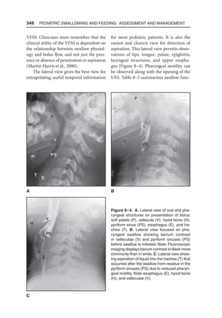 348  Pediatric Swallowing and Feeding: Assessment and Management
VFSS. Clinicians must remember that the
clinical utility of the VFSS is dependent on
the relationship between swallow physiol-
ogy and bolus flow, and not just the pres-
ence or absence of penetration or aspiration
(Martin-Harris et al., 2000).
The lateral view gives the best view for
extrapolating useful temporal information
for most pediatric patients. It is also the
easiest and clearest view for detection of
aspiration. This lateral view permits obser-
vations of lips, tongue, palate, epiglottis,
laryngeal structures, and upper esopha-
gus (Figure 8–4). Pharyngeal motility can
be observed along with the opening of the
UES. Table 8–3 summarizes swallow func-
Figure 8–4. A. Lateral view of oral and pha-
ryngeal structures on presentation of bolus:
soft palate (P), vallecula (V), hyoid bone (H),
pyriform sinus (PS), esophagus (E), and tra-
chea (T). B. Lateral view focused on pha-
ryngeal swallow showing barium contrast
in valleculae (V) and pyriform sinuses (PS)
before swallow is initiated. Note: Fluoroscopic
imaging displays barium contrast in black more
commonly than in white. C. Lateral view show-
ing aspiration of liquid into the trachea (T) that
occurred after the swallow from residue in the
pyriform sinuses (PS) due to reduced pharyn-
geal motility. Note esophagus (E), hyoid bone
(H), and valleculae (V).
C
A B
 