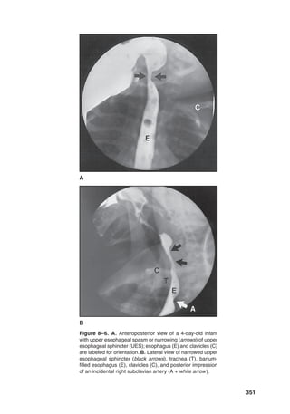 351
Figure 8–6. A. Anteroposterior view of a 4-day-old infant
with upper esophageal spasm or narrowing (arrows) of upper
esophageal sphincter (UES); esophagus (E) and clavicles (C)
are labeled for orientation. B. Lateral view of narrowed upper
esophageal sphincter (black arrows), trachea (T), barium-
filled esophagus (E), clavicles (C), and posterior impression
of an incidental right subclavian artery (A + white arrow).
B
A
 