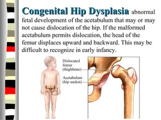 Congenital Hip DysplasiaCongenital Hip Dysplasia abnormal
fetal development of the acetabulum that may or may
not cause dislocation of the hip. If the malformed
acetabulum permits dislocation, the head of the
femur displaces upward and backward. This may be
difficult to recognize in early infancy.
 