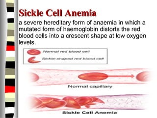 Sickle Cell AnemiaSickle Cell Anemia
a severe hereditary form of anaemia in which a
mutated form of haemoglobin distorts the red
blood cells into a crescent shape at low oxygen
levels.
 