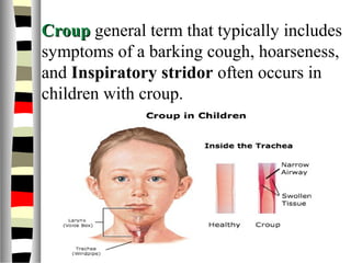 CroupCroup general term that typically includes
symptoms of a barking cough, hoarseness,
and Inspiratory stridor often occurs in
children with croup.
 