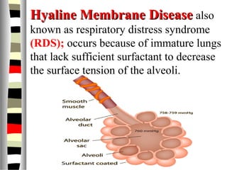 Hyaline Membrane DiseaseHyaline Membrane Disease also
known as respiratory distress syndrome
(RDS); occurs because of immature lungs
that lack sufficient surfactant to decrease
the surface tension of the alveoli.
 