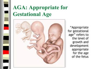 AGA: Appropriate for
Gestational Age
 
