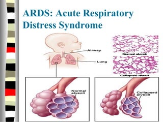 ARDS: Acute Respiratory
Distress Syndrome
 