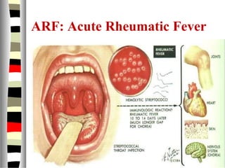 ARF: Acute Rheumatic Fever
 