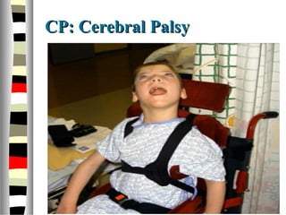 CP: Cerebral PalsyCP: Cerebral Palsy
 
