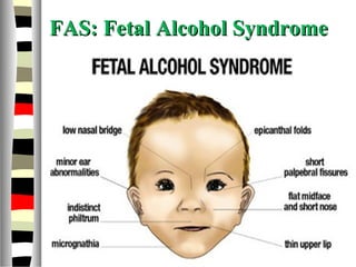 FAS: Fetal Alcohol SyndromeFAS: Fetal Alcohol Syndrome
 