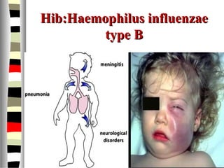 Hib:Haemophilus influenzaeHib:Haemophilus influenzae
type Btype B
 