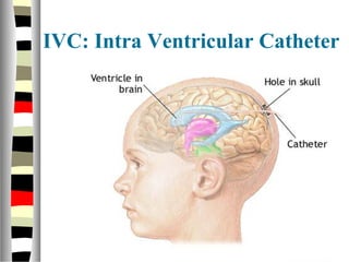 IVC: Intra Ventricular Catheter
 