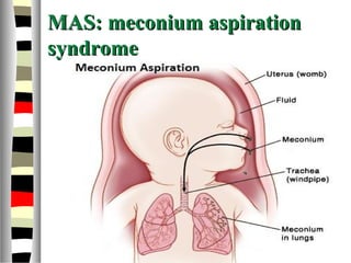 MAS: meconium aspirationMAS: meconium aspiration
syndromesyndrome
 