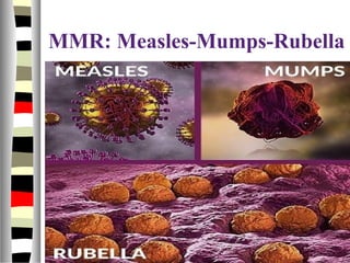 MMR: Measles-Mumps-Rubella
 