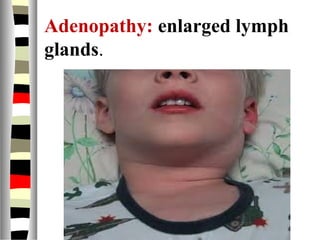 Adenopathy: enlarged lymph
glands.
 