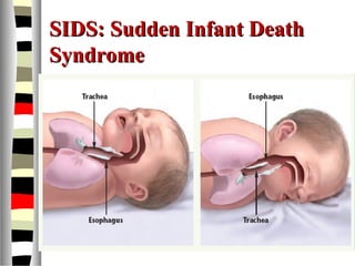 SIDS: Sudden Infant DeathSIDS: Sudden Infant Death
SyndromeSyndrome
 