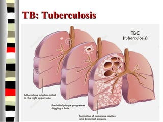 TB: TuberculosisTB: Tuberculosis
 