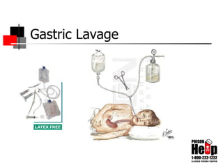 Gastric Lavage 