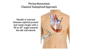 Paraxiphoid Pediatric Trauma | PDF