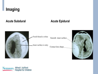 Imaging
Acute Subdural Acute Epidural
 