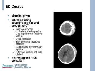 ED Course
 Mannitol given
 Intubated using
ketamine and sux and
brought to CT
– Intraparenchymal
contusions affecting entire
L hemisphere with massive
edema
– Uncal herniation
– Shift of midline structures
of R side
– Compression of ventricular
system
– Extensive fracture of L side
of skull
 Neurosurg and PICU
consults
 