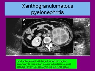 Pediatric urinary tract infection..the role of imaging | PDF
