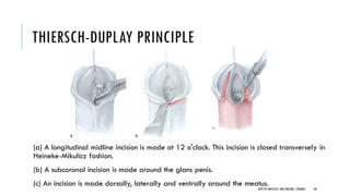 Subcoronal Incision Pediatric urology:Hypospadias- management | PDF