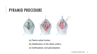 Dorsal Racket Incision Pediatric urology:Hypospadias- management | PDF