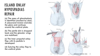 Subcoronal Incision Pediatric urology:Hypospadias- management | PDF